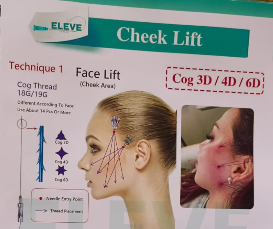 PCL COG 4D Threads for Face & Body Lift – 18G/19G/21G | 20 pcs | Collagen Stimulating | Korea